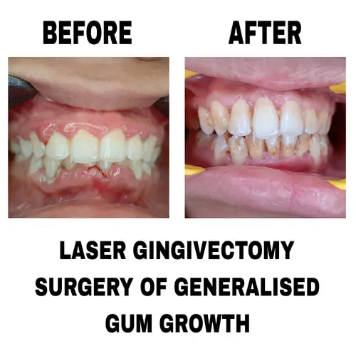 Laser Gingivectomy Surgery of Generalised Gum Growth