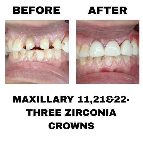 Maxillary 11, 21 & 22 Three Zirconia Crowns