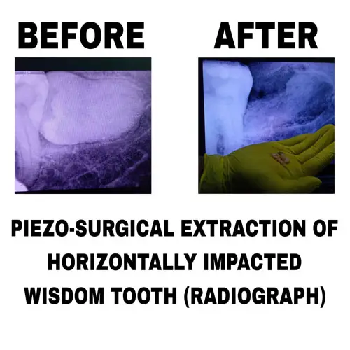 Piezo Surgical Extraction of Horizontally Impacted Wisdom Tooth (Radiograph)