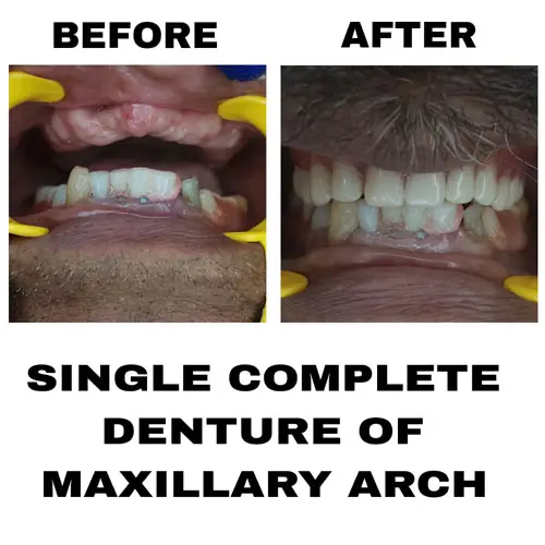 Single Complete Denture of Maxillary ARCH