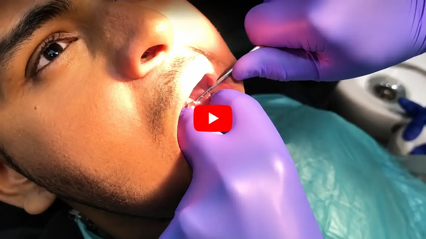 Laser Surgery of Wisdom Tooth at Dentity Dental